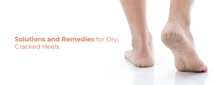 Dry & Cracked Heels: Causes, Treatment, and Prevention