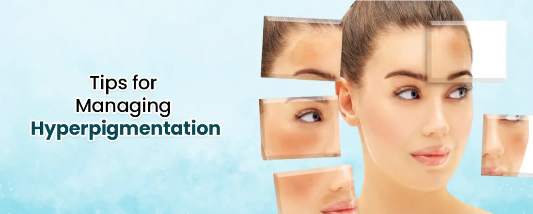 Tips for Managing Hyperpigmentation