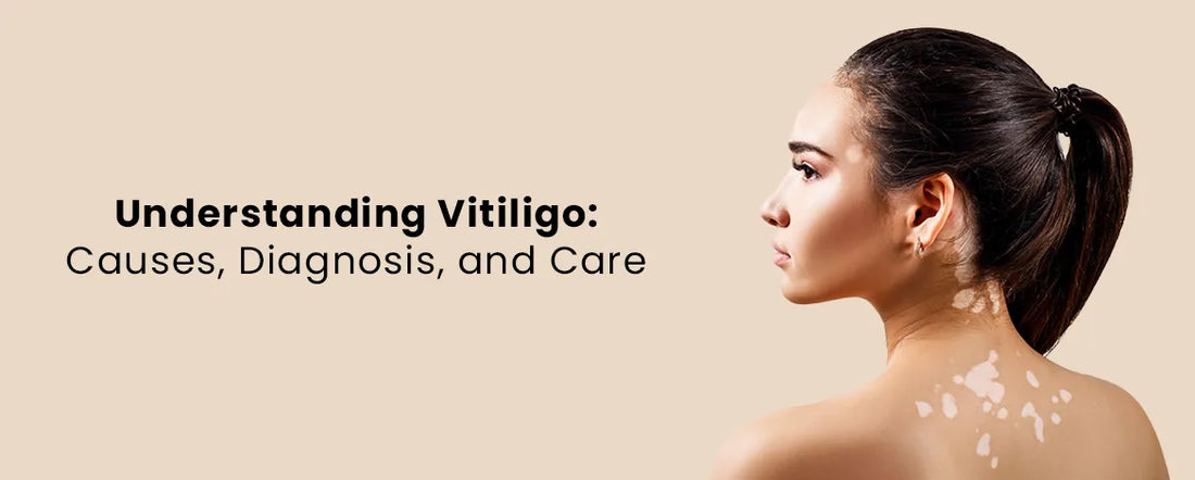 Understanding Vitiligo A Comprehensive Guide to Causes, Diagnosis, and Care