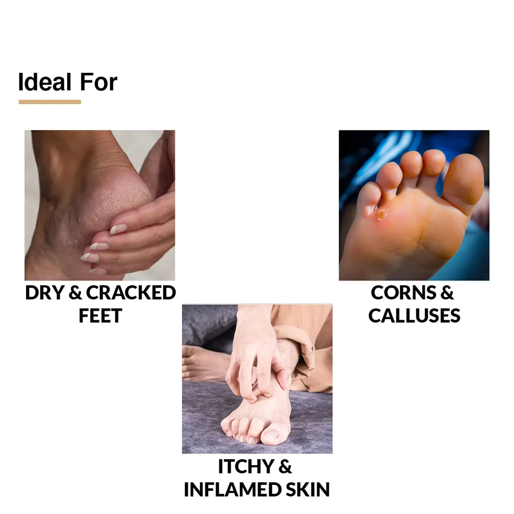 Aashvi Herbs - Care For Cracked Heels - Cream For Dry, Itchy & Rough Flaky  Feet - 40 Gms : Amazon.in: Health & Personal Care