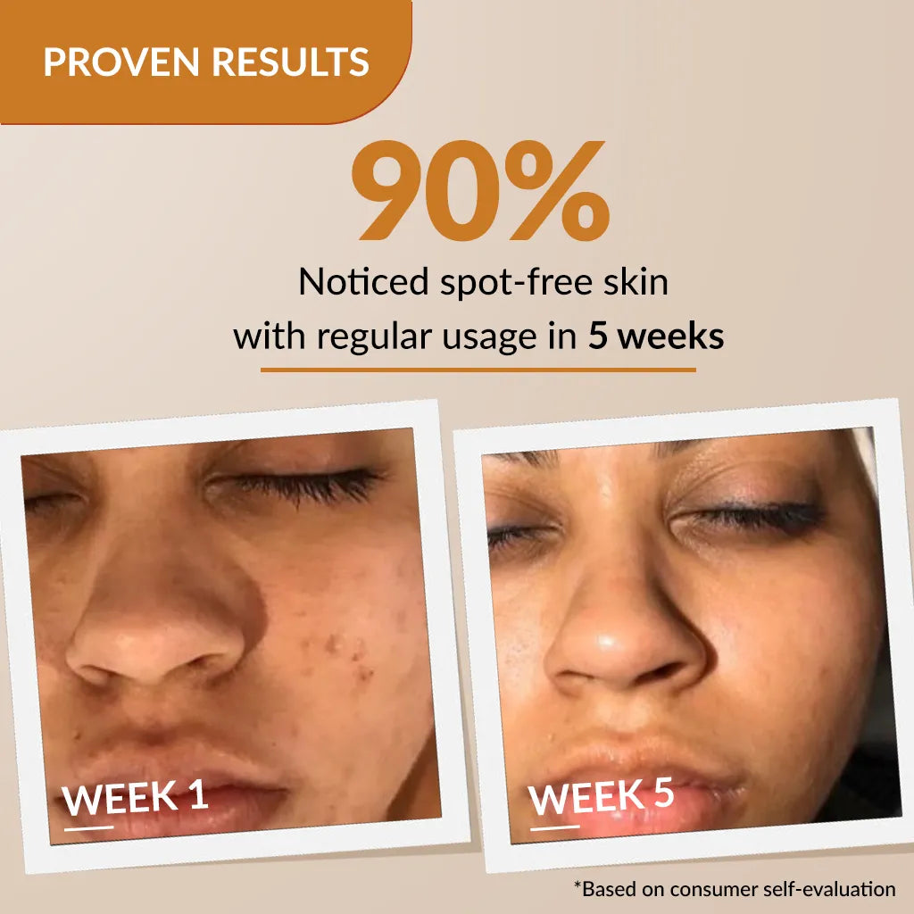 2% Kojic Acid + 1% Arbutin, Skarfix-Plus Scar Removal Cream, Hyperpigmentation and Melasma Treatment